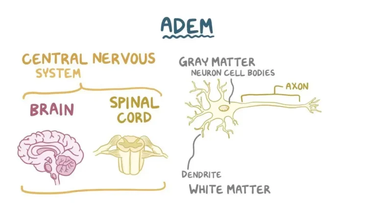 Acute Disseminated Encephalomyelitis (ADEM) Acute Disseminated Encephalomyelitis