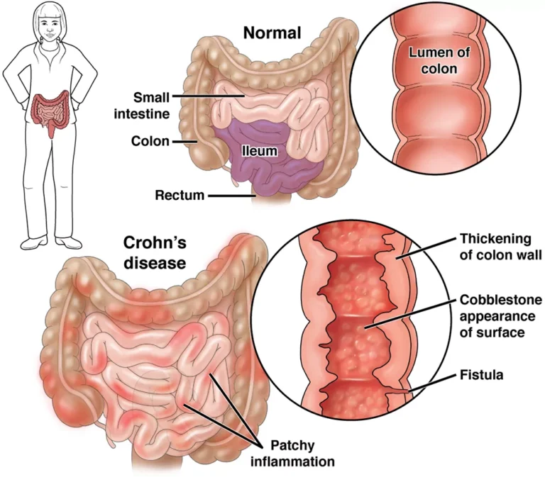 Crohn’s Disease Crohn's Disease