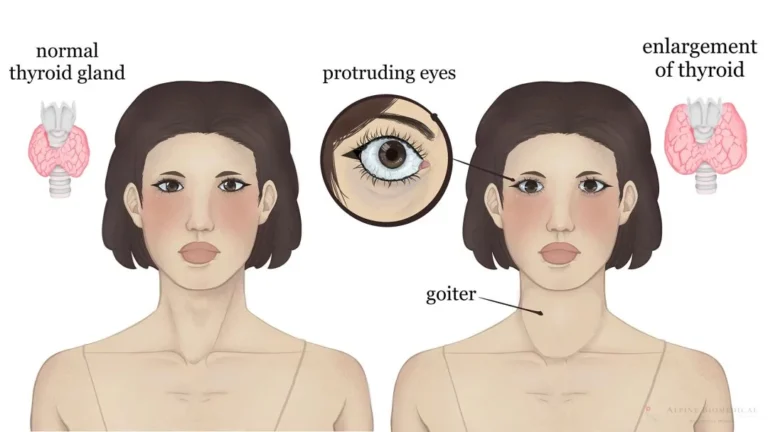 Graves–Basedow Disease (Graves’ Disease) Graves-Basedow Disease