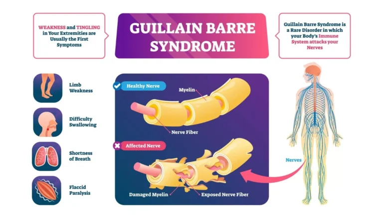 Guillain-Barré Syndrome (GBS) Guillain-Barré Syndrome