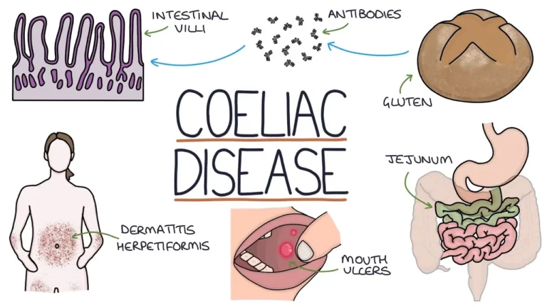 Coeliac Disease (Celiac Disease) Coeliac Disease