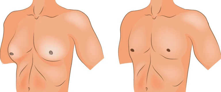 Gynaecomastia (Enlarged Male Breasts): Causes, Checks & Treatment Gynaecomastia