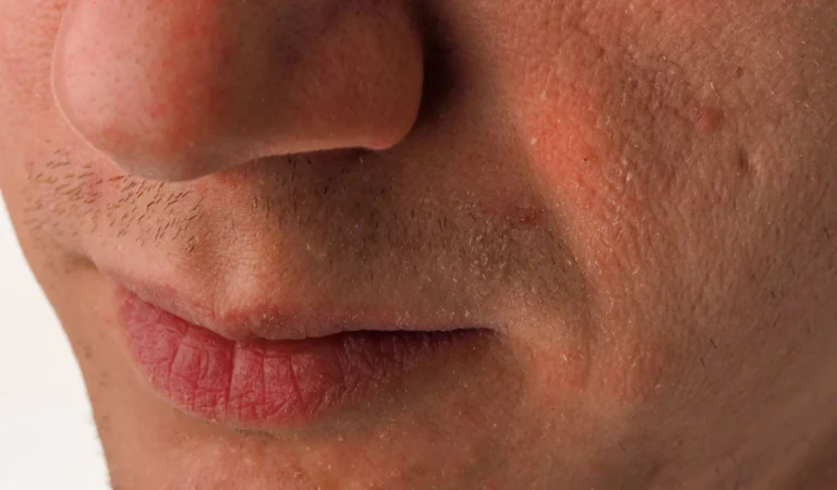 How to Cure Dry Skin Dry Skin