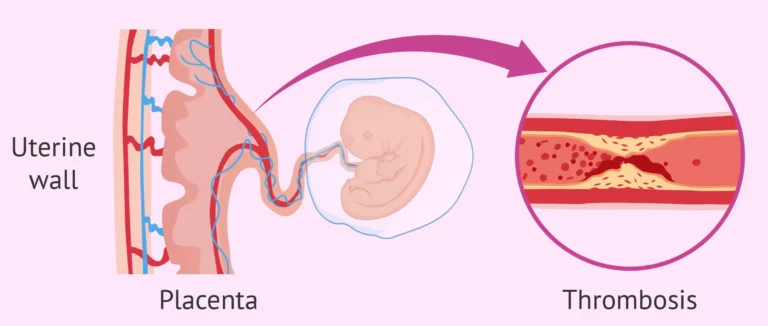 Antiphospholipid Syndrome: Causes, Symptoms, and Treatment Antiphospholipid Syndrome