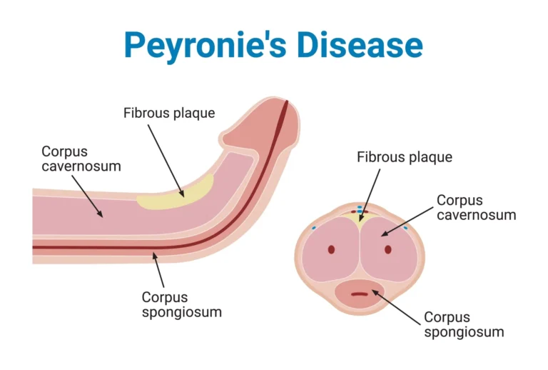 Peyronie's Disease
