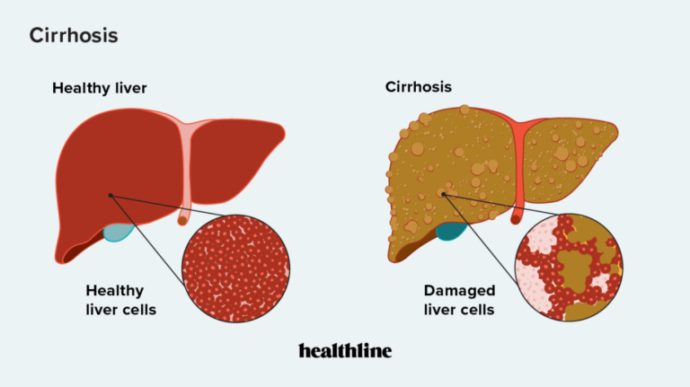 Cirrhosis