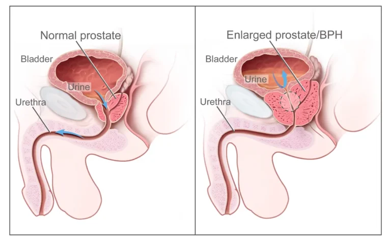 Benign Prostatic Hypertrophy