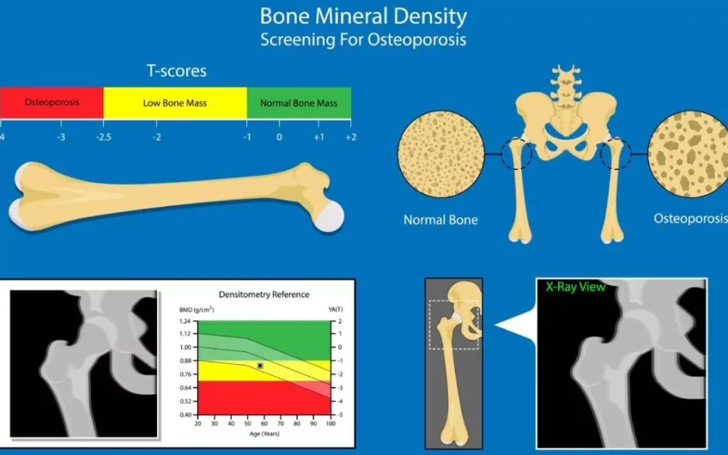 Comparative bone density scans showing differences between sedentary and active individuals