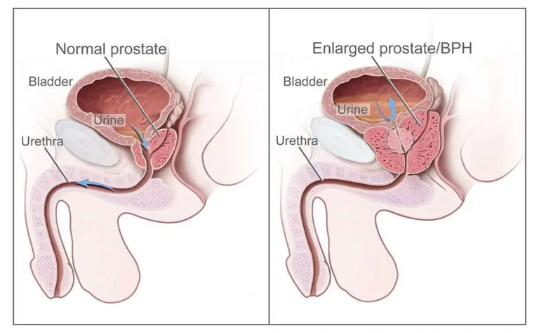prostate